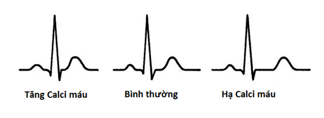 Biến đổi điện tim trong tăng và hạ calci máu