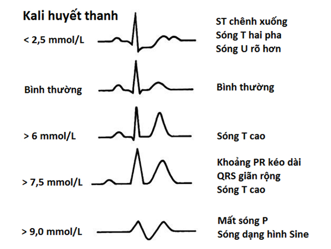 Biến đổi trên ECG trong hạ và tăng kali máu