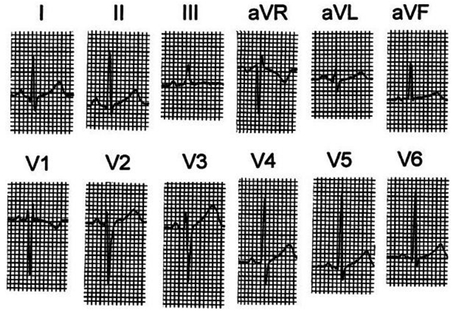 ECG ở một người trưởng thành trẻ tuổi