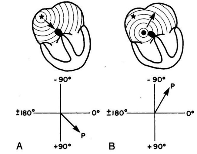 So sánh giữa nhịp xoang (A) và nhịp nhĩ thấp (B)