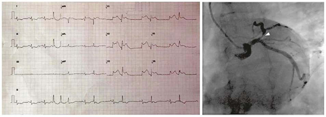 ECG với DII kéo dài cho thấy một vài ngoại tâm thu (NTT) trên thất, sau đó là ngoại tâm thu thất nhịp đôi