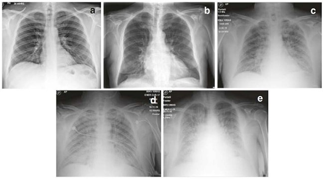 X-quang ngực với tuần hoàn phổi