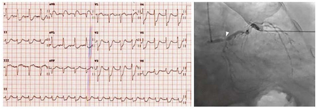 ECG với ST chênh xuống đáng kể ở các chuyển đạo bên và trước tim và ST chênh lên ở aVR