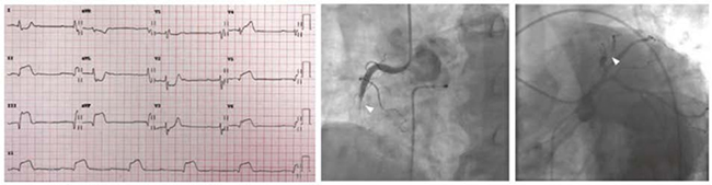 ECG với block AV III với nhịp thoát bộ nối và ST chênh lên trong các chuyển đạo thành dưới và V5-V6