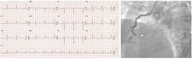 ECG với ST chênh lên ở thành dưới (DII, DIII, aVF) tương ứng với tắc hoàn toàn đoạn xa của động mạch vành phải