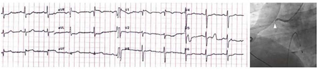 ECG cho thấy ST chênh lên thành dưới (DII, DIII) do tắc động mạch vành phải đoạn gần