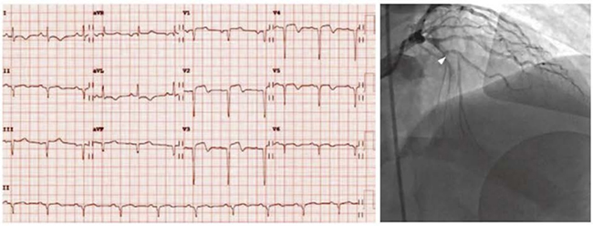 ECG với STEM thành trước. ST chênh lên được tìm thấy ở V2, V3 và mở rộng đến V4