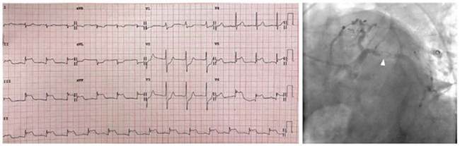 ECG với ST chênh lên ở thành dưới cũng như ST chênh lên ở V5-V6