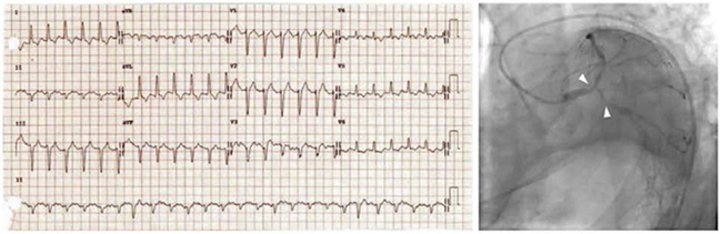 ECG với cuồng nhĩ và LBBB mới khởi phát được gây ra bởi một tổn thương chổ chia đôi