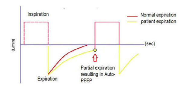 Biểu đồ sóng lưu lượng cho thấy thở ra không hoàn toàn, tạo nên bẫy khí và auto-PEEP