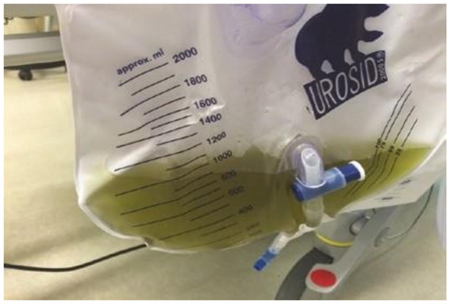 Nước tiểu màu xanh lục nhạt ở một bệnh nhân dùng thuốc nhuộm xanh methylen