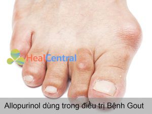 Allopurinol dùng trong điều trị Bệnh Gout