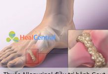 Thuốc Allopurinol điều trị bệnh Gout