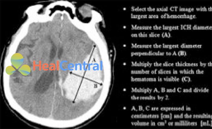 cấp cứu xuất huyết nội sọ