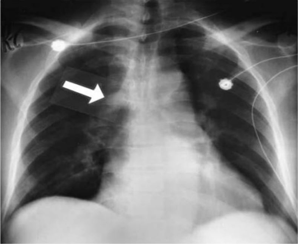 X quang phổi cho thấy một tĩnh mạch azygos khổng lồ