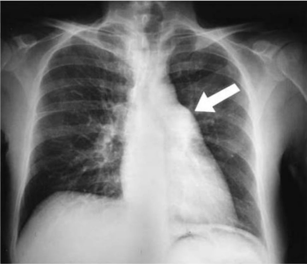 X quang phổi cho thấy sự mở rộng đáng kể của động mạch phổi chính