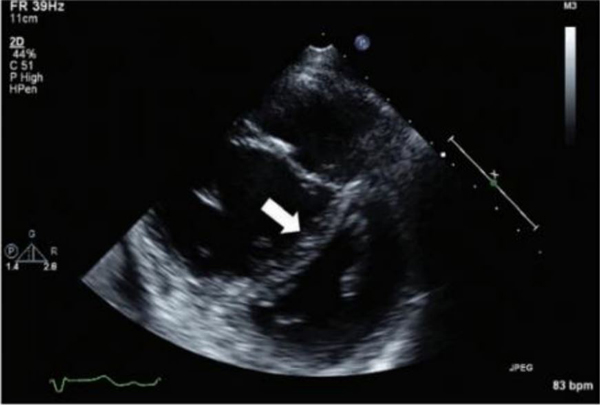 Hình ảnh siêu âm tim cho thấy sự dịch chuyển rõ rệt của vách liên thất về phía tâm thất trái