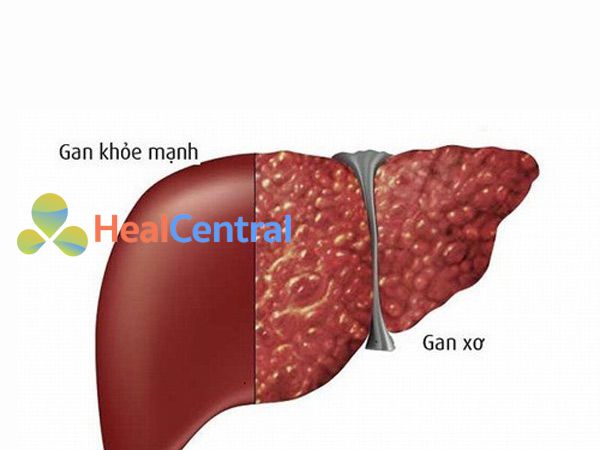 Hình ảnh lá gan giảm dần chức năng và dẫn đến bệnh xơ gan