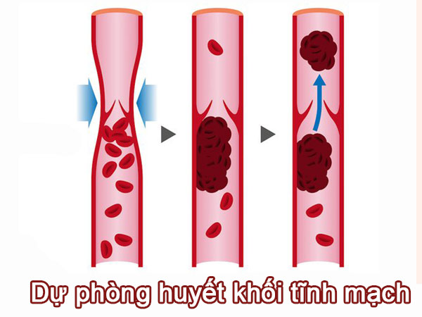 Dự phòng huyết khối tĩnh mạch