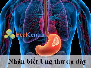 Cách nhận biết Ung thư dạ dày