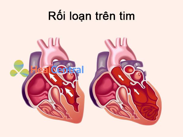 Những rối loạn xảy ra trên tim