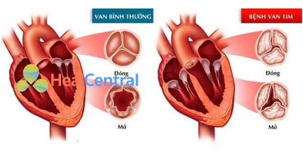 Suy chức năng van tim