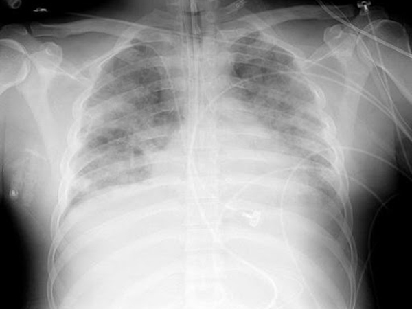 Hình ảnh X Quang phổi bệnh nhân Suy hô hấp cấp tính