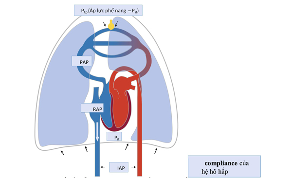 Hình. 1 Sơ đồ biểu diễn tác động của tăng áp lực ổ bụng lên hệ thống tim mạch.