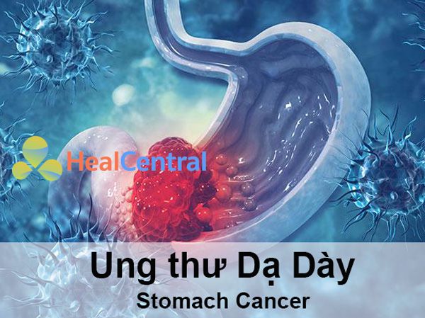 Ung thư Dạ Dày | Tổng quan, Nguyên nhân, Dấu hiệu, Hướng Điều trị