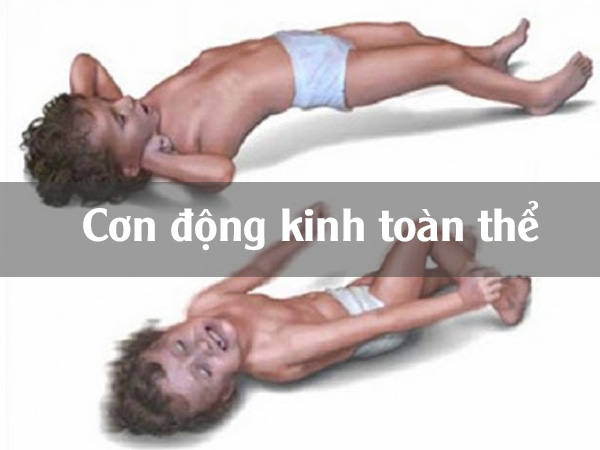 Cơn động kinh toàn thể