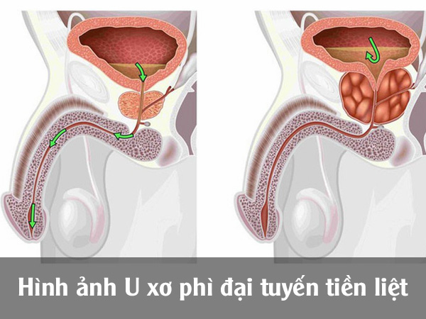 Hình ảnh U xơ phì đại tuyến tiền liệt