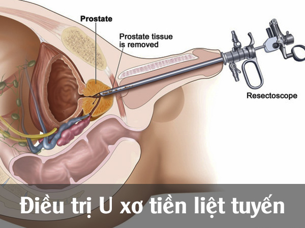 Điều trị U xơ tiền liệt tuyến