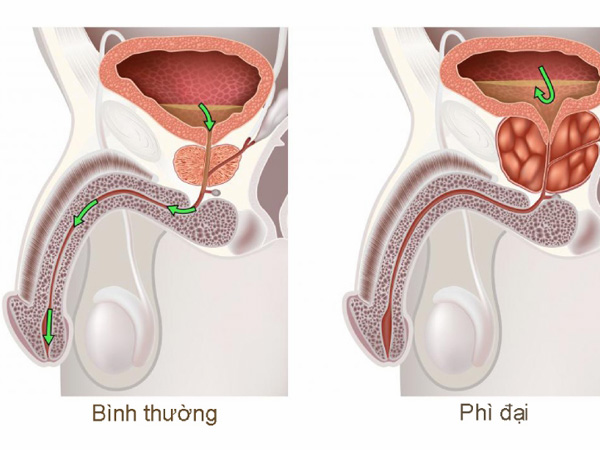 Hình ảnh: Bệnh phì đại tuyến tiền liệt