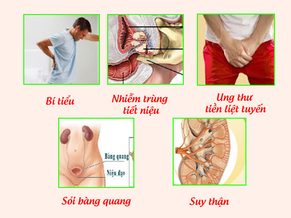 Biến chứng của phì đại tuyến tiền liệt