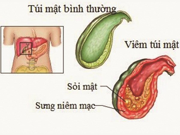 Hình ảnh túi sỏi mật