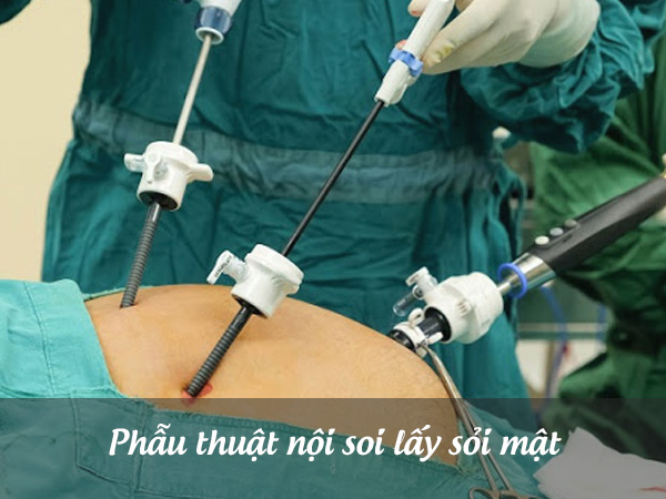 Phẫu thuật nội soi lấy sỏi mật