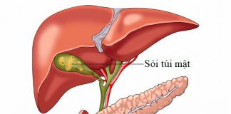 Bệnh sỏi mật