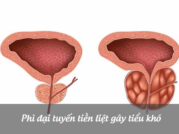 Phì đại tuyến tiền liệt gây ra khó tiểu