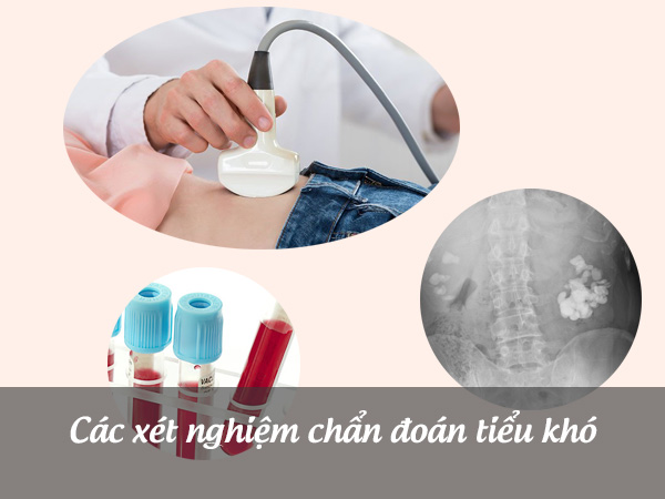 Xét nghiệm chẩn đoán tiểu khó