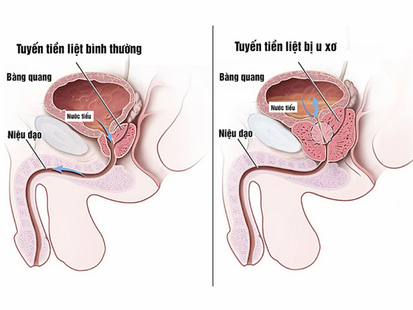 Hình ảnh U xơ tuyến tiền liệt