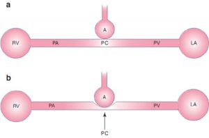 Hình 10.5 Sơ đồ mạch máu phổi. (a) Các mao mạch phổi của phế nang. (b) Với lực căng phế nang do thông khí áp lực dương, mao mạch phổi có thể bị nén, làm tăng sức cản mạch máu phổi và hậu tải thất phải. A: phế nang; LA: tâm nhĩ trái; PA: động mạch phổi; PC: mao mạch phổi; PV: tĩnh mạch phổi; RV: tâm thất phải