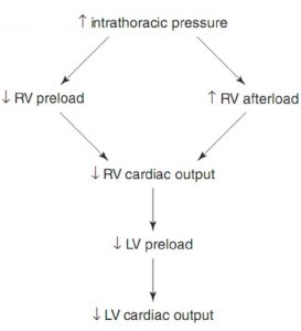 Hình 10.7 Áp lực trong lồng ngực tăng lên ảnh hưởng đến các điều kiện tải tâm thất phải, dẫn đến giảm cung lượng tim. RV: tâm thất phải; LV: tâm thất trái