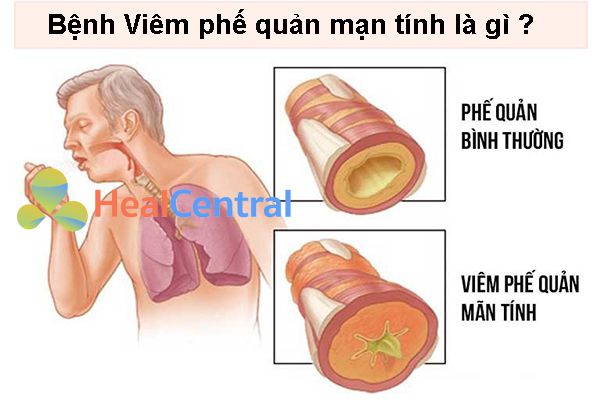 Bệnh viêm phế quản mạn là gì ?