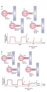 Hình 6.3 Thao tác tạm dừng thở ra thể hiện auto- PEEP. (a) Ví dụ về thao tác tạm dừng thở ra trong bối cảnh sức cản đường thở bình thường. Khi thở ra, van thở đóng lại, không cho phép bất kỳ không khí nào rời khỏi hệ hô hấp. Bởi vì áp lực phế nang bằng áp lực đường thở gần cuối thì thở ra, không có lưu lượng bổ sung từ phế nang đến máy thở; do đó, áp lực đường thở gần vẫn không thay đổi khi kết thúc quá trình tạm dừng thở ra và không có PEEP nội tại. Do đó, tổng PEEP bằng với PEEP bên ngoài. (b) Ví dụ về thao tác tạm dừng thở ra trong bối cảnh sức cản đường thở tăng đáng kể. Khi thở ra, van thở đóng lại, không cho phép bất kỳ không khí nào rời khỏi hệ hô hấp. Bởi vì áp lực phế nang vẫn cao hơn áp lực đường thở ở cuối thì thở ra, có thêm lưu lượng khí từ phế nang đến máy thở, tiếp tục làm tăng áp lực đường thở gần. Sự gia tăng thêm áp lực đường thở ở cuối khi thở ra được gọi là PEEP nội tại hoặc PEEP tự động. Trong trường hợp này, PEEP tổng là 12 cm H2O, PEEP ngoài (PEEP cài đặt) là 5 cm H2O, vì vậy PEEP tự động là 7 cm H2O.