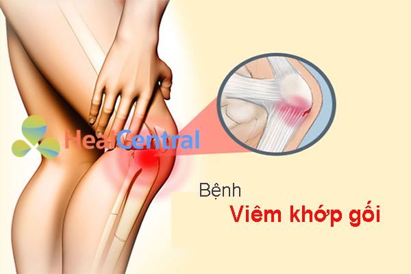 bệnh viêm khớp gối là gì ?