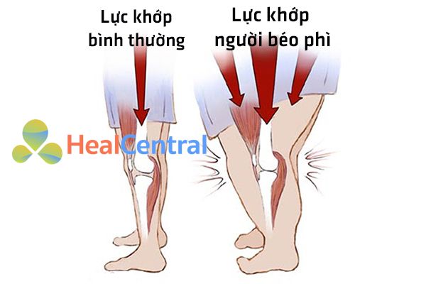 béo phì là yếu tố nguy cơ dẫn đến viêm khớp gối