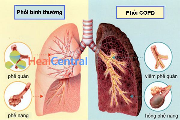 Biến chứng bệnh phổi tắc nghẽn mạn tính (COPD)