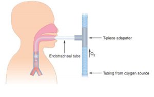 Hình 9.1 Thở qua ống chữ T. Bệnh nhân bị ngắt kết nối với máy thở, nhưng ống nội khí quản vẫn nằm trong đường thở. Một bộ chuyển đổi hình chữ T được gắn vào cuối ống nội khí quản, cho phép cung cấp oxy ẩm.