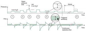 HÌNH 1.11 (1), Nhịp thở thông khí hỗ trợ thể tích (5 cm H2O); (2), áp lực được tăng chậm cho đến khi đạt được thể tích mục tiêu; (3), áp lực tối đa khả dụng là 5 cm H2O dưới giới hạn áp lực trên; (4), thể tích khí lưu thông cao hơn thể tích khí lưu thông đã đưa ra dẫn đến áp lực thấp hơn; (5), bệnh nhân có thể kích hoạt nhịp thở; (6), nếu phát hiện cảnh báo ngưng thở, máy thở sẽ chuyển sang thông khí thể tích được điều chỉnh bằng áp lực. (Mẫu nhịp thở thử nghiệm và cung cấp nhịp thở 5 cm H2O là các tính năng của thiết kế ban đầu; những mẫu này đã được sửa đổi trong các mẫu mới hơn của Servo 300 và Servo-i.) Cho phép của Maquet, Inc., Wayne, NJ.