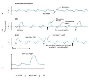 HÌNH 1.6 Dạng sóng áp lực cho thấy sự khác biệt thiết yếu trong (A) thông khí tự phát; (B) thông khí bắt buộc ngắt quãng (IMV); (C) thông khí bắt buộc ngắt quãng đồng bộ (SIMV); D, IMV với áp lực dương cuối thì thở ra (PEEP). Lưu ý rằng trong quá trình thông khí bắt buộc ngắt quãng, nhịp thở bắt buộc (mũi tên thẳng đứng) và nhịp thở tự nhiên không được đồng bộ hóa. Từ Dupuis Y. Ventilators: Theory and Clinical Application, 2nd ed. St. Louis, MO: Mosby; 1992.